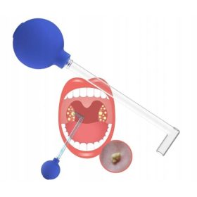    Strumento manuale per la rimozione dei calcoli delle tonsille